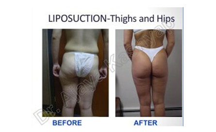 liposuction delhi