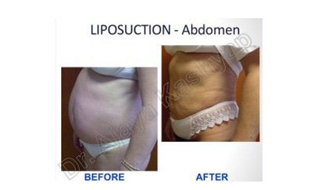 360 high-definition liposuction india
