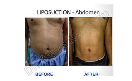 six pack abs surgery in New Delhi