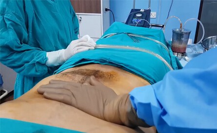 vaser liposuction in India