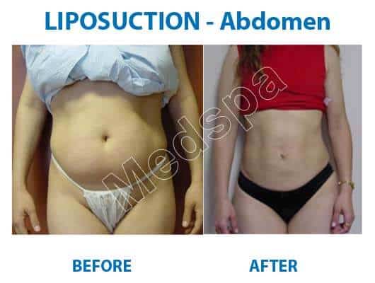 abdomen liposuction surgery