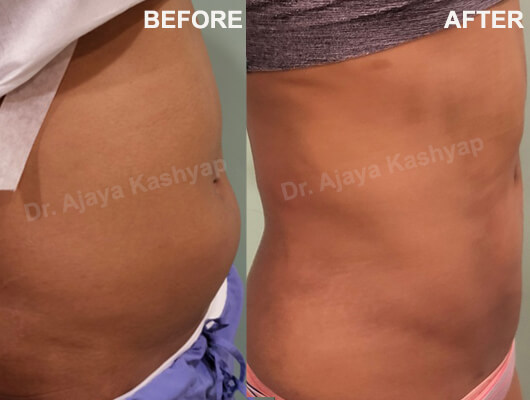 abdomen liposuction surgery