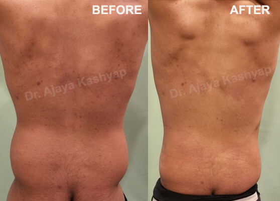 abdomen lipo surgery