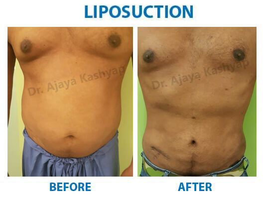 abdomen liposuction surgery cost