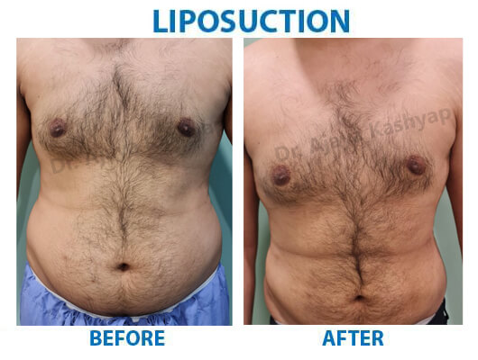 liposuction clinic