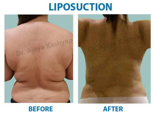 liposuction surgery cost