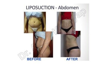 abdominal etching cost in delhi